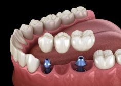 Animateddental implant supported fixed bridge placement