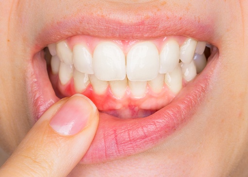 Smile with inflamed gum tissue in need of gum disease treatment