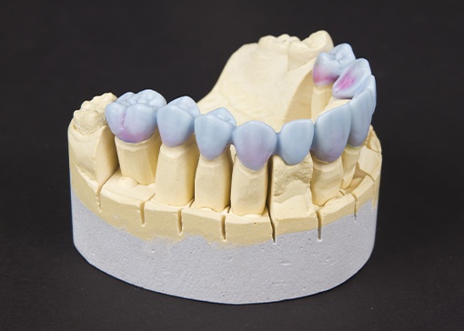 Wax up model of smile with dental restorations