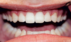 Perfectly aligned smile after tooth colored braces treatment
