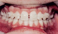 Smile during tooth colored braces treatment