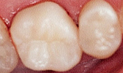 Two teeth with tooth colored fillings