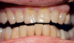 Yellowed teeth before teeth whitening