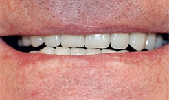 Flawless smile after dental restoration