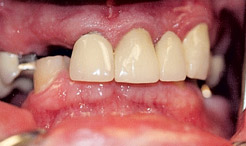 Smile with missing and damaged teeth