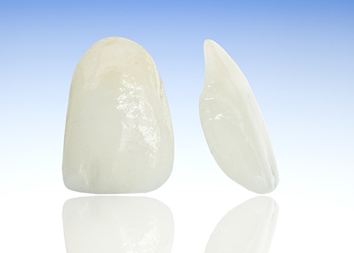 Two sample porcelain veneers prior to placement