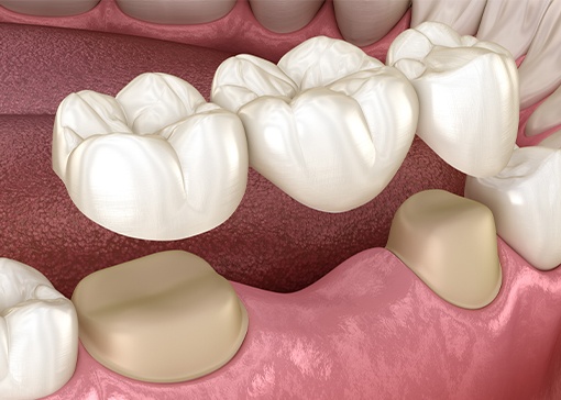 Animated smile during fixed bridge placement