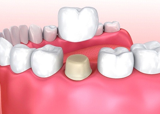 3D illustration of a dental crown capping a prepared tooth