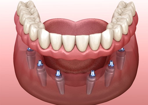 Digital illustration of implant dentures