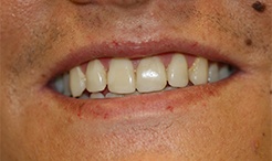 Smile after composite filling in teeth