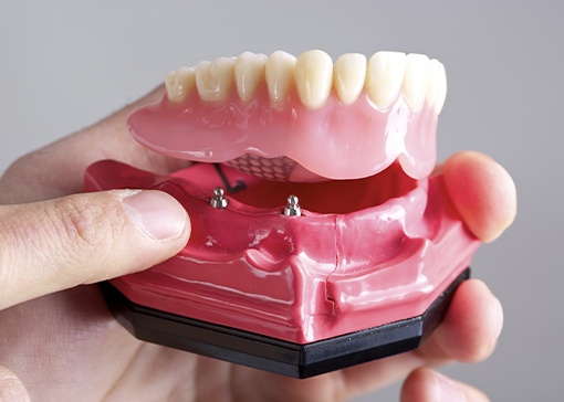 Model dental implant supported denture