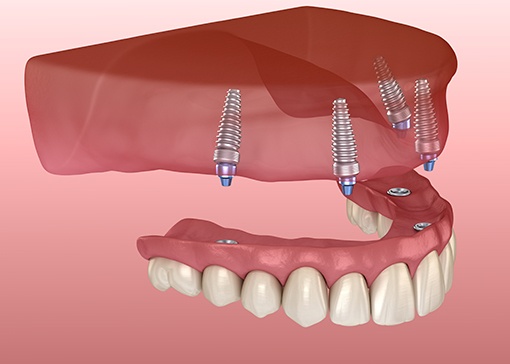 Animated dental implant supported denture placement