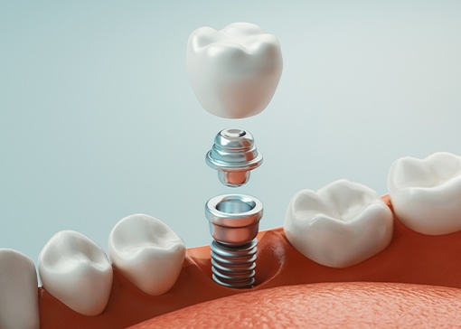 Animated dental implant supported dental crown placement