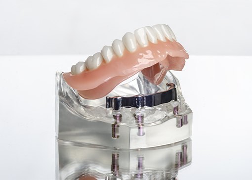 Model dental implant supported denture