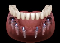 Animated dental implant supported denture placement