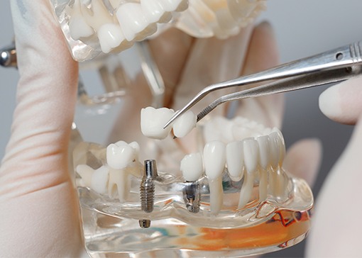 Model dental implant supported fixed bridge