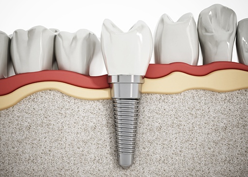 Animated smile with dental implant supported dental crown