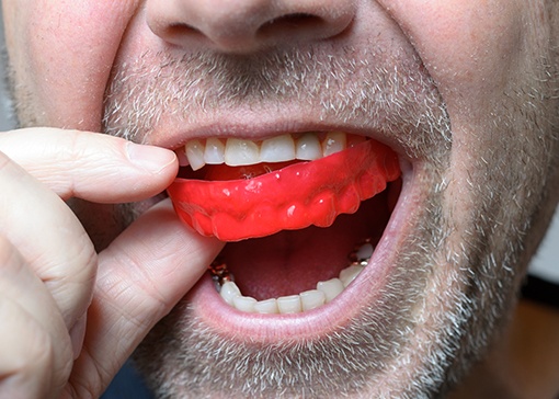 Man placing a custom athletic mouthguard