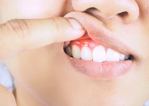 Closeup of patient with gum disease pointing to gums