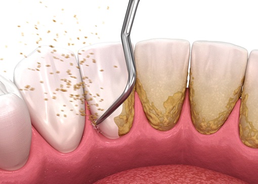 Illustration of dental tool removing plaque and tartar