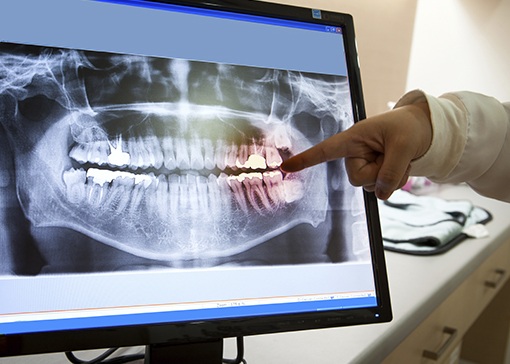 Digital x-rays on computer monitor