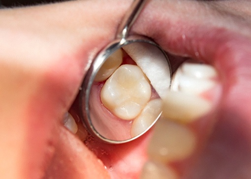 dentist holding a dental crown on their finger