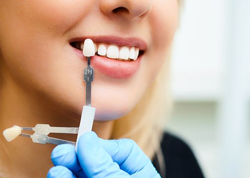 Patient's smile compared with porcelain veneer shade