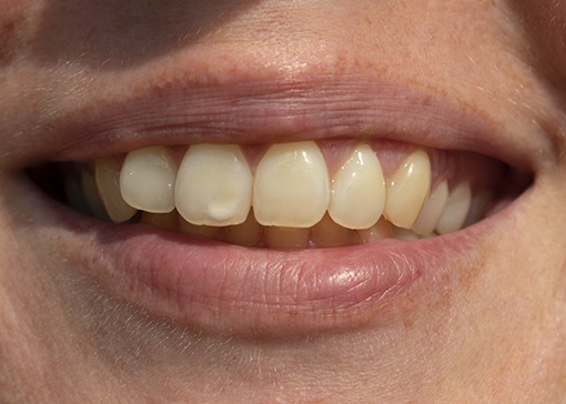 Closeup of discolored smile