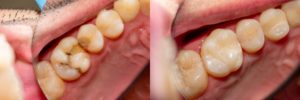 molars before and after tooth-colored fillings 
